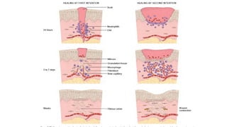 Presentation on Scar Formation in the process of wound healing | PPTX