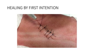 HEALING BY FIRST INTENTION
 