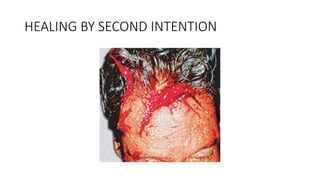 HEALING BY SECOND INTENTION
 