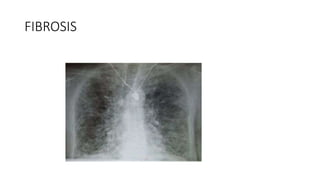 FIBROSIS
 