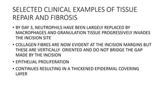 SELECTED CLINICAL EXAMPLES OF TISSUE
REPAIR AND FIBROSIS
• BY DAY 3, NEUTROPHILS HAVE BEEN LARGELY REPLACED BY
MACROPHAGES AND GRANULATION TISSUE PROGRESSIVELY INVADES
THE INCISION SITE
• COLLAGEN FIBRES ARE NOW EVIDENT AT THE INCISION MARGINS BUT
THESE ARE VERTICALLY ORIENTED AND DO NOT BRIDGE THE GAP
MADE BY THE INCISION
• EPITHELIAL PROLIFERATION
• CONTINUES RESULTING IN A THICKENED EPIDERMAL COVERING
LAYER
 