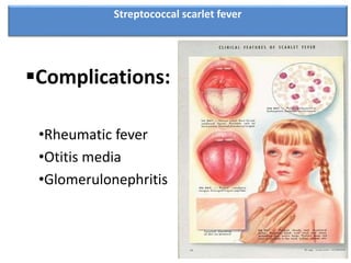 Complications:
•Rheumatic fever
•Otitis media
•Glomerulonephritis
Streptococcal scarlet fever
 