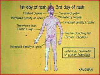 Strep Rash Distribution Scarlet Fever Rash