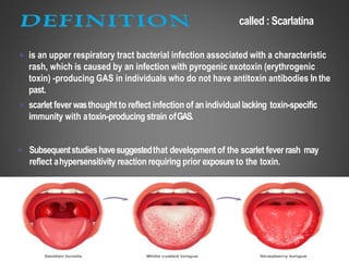 Infectious diseases: Scarlet fever