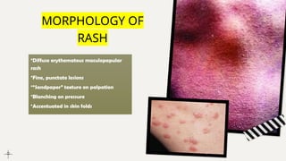 Diffuse Punctate Rash Comprehensive Dermatological Overview of Scarlet Fever in Children | PPTX