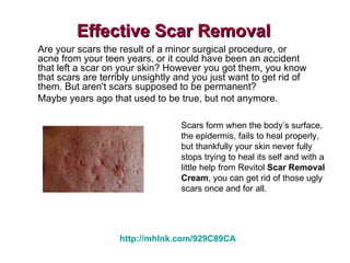 Effective Scar Removal Are your scars the result of a minor surgical procedure, or acne from your teen years, or it could have been an accident that left a scar on your skin? However you got them, you know that scars are terribly unsightly and you just want to get rid of them. But aren't scars supposed to be permanent? Maybe years ago that used to be true, but not anymore. Scars form when the body’s surface, the epidermis, fails to heal properly, but thankfully your skin never fully stops trying to heal its self and with a little help from Revitol  Scar Removal Cream , you can get rid of those ugly scars once and for all. http://mhlnk.com/929C89CA 