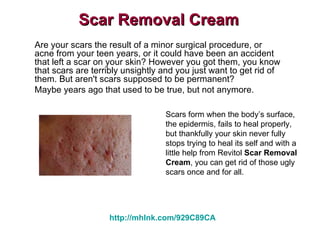 Scar Removal Cream Are your scars the result of a minor surgical procedure, or acne from your teen years, or it could have been an accident that left a scar on your skin? However you got them, you know that scars are terribly unsightly and you just want to get rid of them. But aren't scars supposed to be permanent? Maybe years ago that used to be true, but not anymore. Scars form when the body’s surface, the epidermis, fails to heal properly, but thankfully your skin never fully stops trying to heal its self and with a little help from Revitol  Scar Removal Cream , you can get rid of those ugly scars once and for all. http://mhlnk.com/929C89CA 