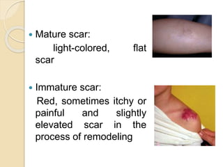 Maturing Scar Scarring of wounds | PPTX