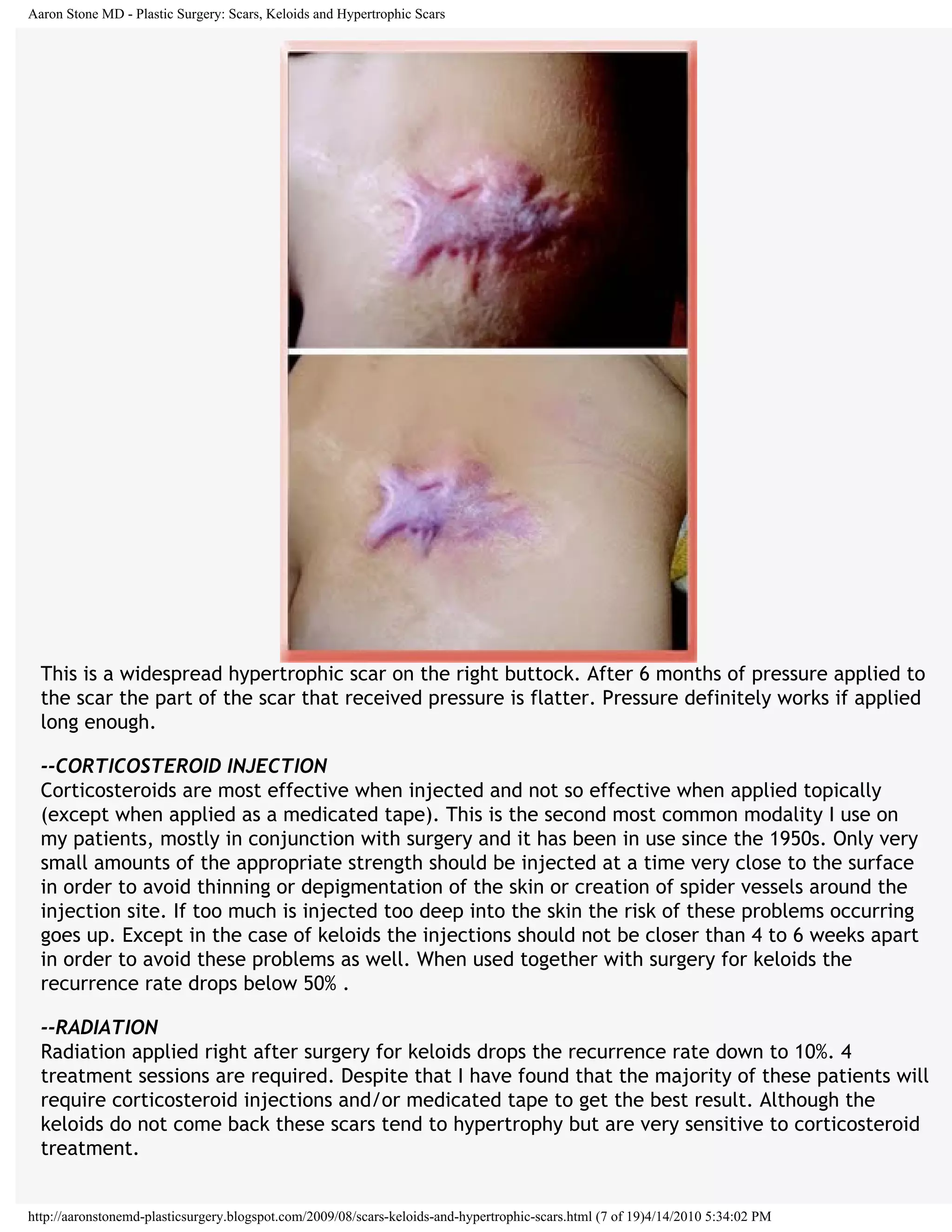 Scars keloids and hypertrophic-scars | PDF