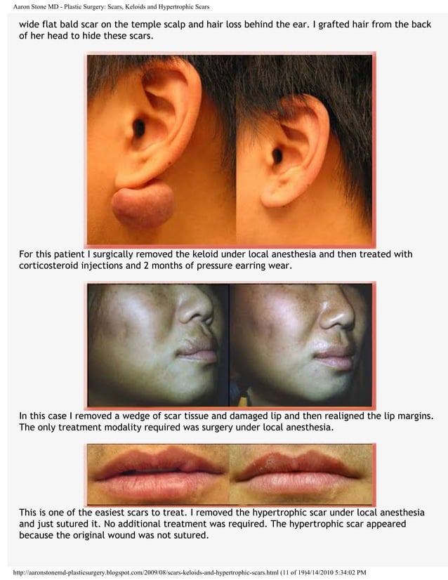 Scars keloids and hypertrophicscars