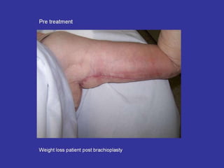 Scar Tissue Therapy Presentation Plastics