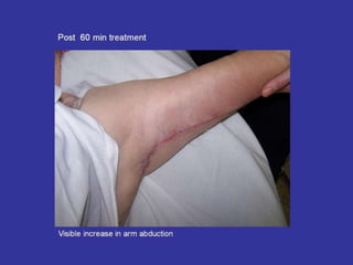 Scar Tissue Therapy Presentation Plastics