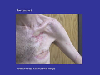 Scar Tissue Therapy Presentation Plastics