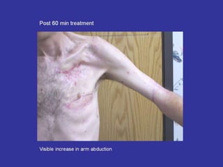 Scar Tissue Therapy Presentation Plastics