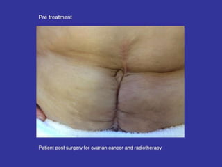 Scar Tissue Therapy Presentation Plastics