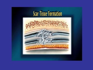 Scar Tissue Therapy Presentation Plastics