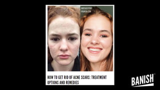 HOW TO GET RID OF ACNE SCARS: TREATMENT OPTIONS AND REMEDIES