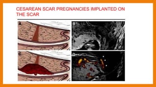 CESAREAN SCAR PREGNANCIES IMPLANTED ON
THE SCAR
 