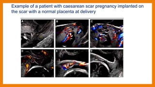 Example of a patient with caesarean scar pregnancy implanted on
the scar with a normal placenta at delivery
 