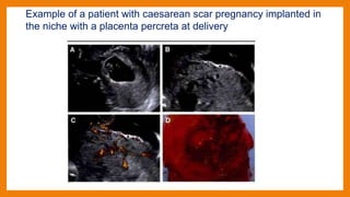 Example of a patient with caesarean scar pregnancy implanted in
the niche with a placenta percreta at delivery
 