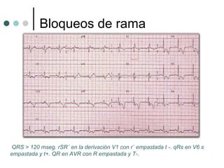 Bloqueos de rama QRS > 120 mseg. rSR´ en la derivación V1 con r´ empastada t -. qRs en V6 s empastada y t+. QR en AVR con R empastada y T-. 