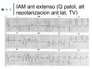 IAM ant extenso (Q patol, alt repolarizacion ant lat, TV) 