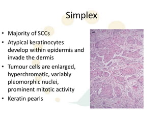 Simplex
• Majority of SCCs
• Atypical keratinocytes
  develop within epidermis and
  invade the dermis
• Tumour cells are enlarged,
  hyperchromatic, variably
  pleomorphic nuclei,
  prominent mitotic activity
• Keratin pearls
 