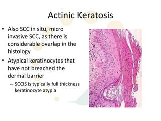 Actinic Keratosis
• Also SCC in situ, micro
  invasive SCC, as there is
  considerable overlap in the
  histology
• Atypical keratinocytes that
  have not breached the
  dermal barrier
   – SCCIS is typically full thickness
     keratinocyte atypia
 