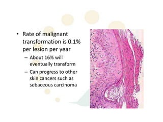 • Rate of malignant
  transformation is 0.1%
  per lesion per year
   – About 16% will
     eventually transform
   – Can progress to other
     skin cancers such as
     sebaceous carcinoma
 