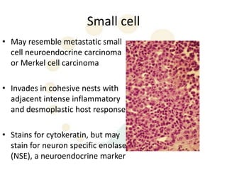 Small cell
• May resemble metastatic small
  cell neuroendocrine carcinoma
  or Merkel cell carcinoma

• Invades in cohesive nests with
  adjacent intense inflammatory
  and desmoplastic host response

• Stains for cytokeratin, but may
  stain for neuron specific enolase
  (NSE), a neuroendocrine marker
 