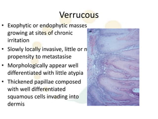 Verrucous
• Exophytic or endophytic masses
  growing at sites of chronic
  irritation
• Slowly locally invasive, little or no
  propensity to metastasise
• Morphologically appear well
  differentiated with little atypia
• Thickened papillae composed
  with well differentiated
  squamous cells invading into
  dermis
 