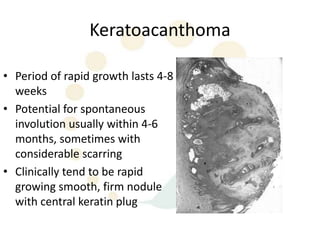 Keratoacanthoma

• Period of rapid growth lasts 4-8
  weeks
• Potential for spontaneous
  involution usually within 4-6
  months, sometimes with
  considerable scarring
• Clinically tend to be rapid
  growing smooth, firm nodule
  with central keratin plug
 