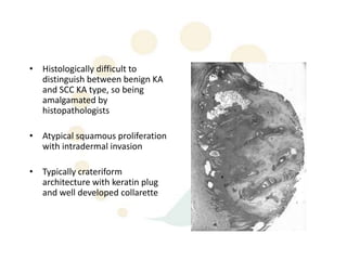• Histologically difficult to
  distinguish between benign KA
  and SCC KA type, so being
  amalgamated by
  histopathologists

• Atypical squamous proliferation
  with intradermal invasion

• Typically crateriform
  architecture with keratin plug
  and well developed collarette
 
