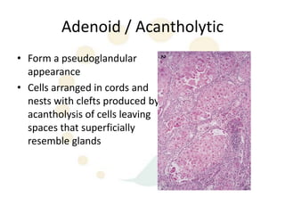 Adenoid / Acantholytic
• Form a pseudoglandular
  appearance
• Cells arranged in cords and
  nests with clefts produced by
  acantholysis of cells leaving
  spaces that superficially
  resemble glands
 