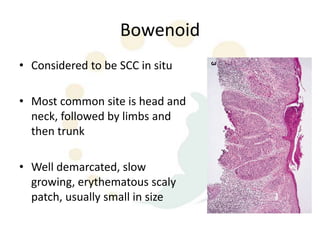 Bowenoid
• Considered to be SCC in situ

• Most common site is head and
  neck, followed by limbs and
  then trunk

• Well demarcated, slow
  growing, erythematous scaly
  patch, usually small in size
 
