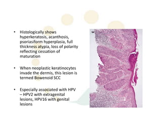 • Histologically shows
  hyperkeratosis, acanthosis,
  psoriasiform hyperplasia, full
  thickness atypia, loss of polarity
  reflecting cessation of
  maturation

• When neoplastic keratinocytes
  invade the dermis, this lesion is
  termed Bowenoid SCC

• Especially associated with HPV
  – HPV2 with extragenital
  lesions, HPV16 with genital
  lesions
 