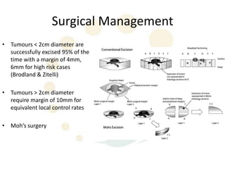 Surgical Management
• Tumours < 2cm diameter are
  successfully excised 95% of the
  time with a margin of 4mm,
  6mm for high risk cases
  (Brodland & Zitelli)

• Tumours > 2cm diameter
  require margin of 10mm for
  equivalent local control rates

• Moh’s surgery
 