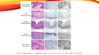 SQUAMOUS CELL CARCINOMA - ORAL CANCER PPT | PPTX