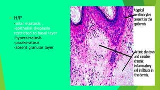  H/P
-solar elastosis ,
-epithelial dysplasia
restricted to basal layer
-hyperkeratosis
-parakeratosis
-absent granular layer
 