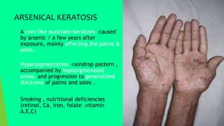 ARSENICAL KERATOSIS
 A corn like punctate keratosis caused
by arsenic / a few years after
exposure, mainly affecting the palms &
soles.
 Hyperpigmentation –raindrop pattern ,
accompanied by hypopigmenated
areas, and progression to generalized
thickness of palms and soles .
 Smoking , nutritional deficiencies
(retinol, Ca, iron, folate ,vitamin
A,E,C)
 