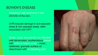 BOWEN’S DISEASE
 Squamous cell carcinoma in situ
(SCCIS) of the skin.
 UVR-induced damage in sun-exposed
areas & non exposed areas, often
associated with HPV
 Single, large, persistently non-elevated,
well demarcated, erythematous plaque,
with white-to-yellow scale – moist ,
reddened, granular surface on
detachment with no bleeding point.
 