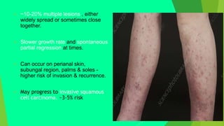  ~10-20% multiple lesions , either
widely spread or sometimes close
together.
 Slower growth rate and spontaneous
partial regression at times.
 Can occur on perianal skin,
subungal region, palms & soles -
higher risk of invasion & recurrence.
 May progress to invasive squamous
cell carcinoma. ~3-5% risk
 