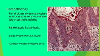 Histopathology
 Full thickness epidermal dysplasia
& disordered differentiation with
loss of epithelial polarity.
 Parakeratosis & acanthosis.
 Large hyperchromatic nuclei
 Atypical mitosis and gaint cells.
 