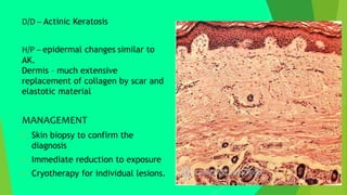 D/D – Actinic Keratosis
H/P – epidermal changes similar to
AK.
Dermis – much extensive
replacement of collagen by scar and
elastotic material
MANAGEMENT
 Skin biopsy to confirm the
diagnosis
 Immediate reduction to exposure
 Cryotherapy for individual lesions.
 