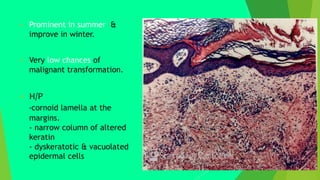  Prominent in summer &
improve in winter.
 Very low chances of
malignant transformation.
 H/P
-cornoid lamella at the
margins.
- narrow column of altered
keratin
- dyskeratotic & vacuolated
epidermal cells
 