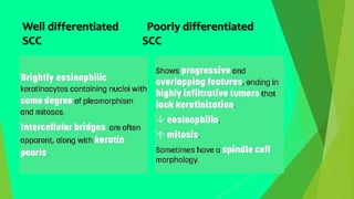 Well differentiated Poorly differentiated
SCC SCC
 
