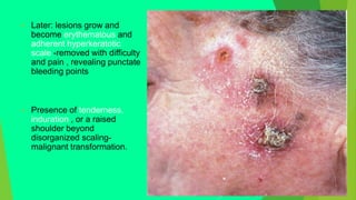  Later: lesions grow and
become erythematous and
adherent hyperkeratotic
scale -removed with difficulty
and pain , revealing punctate
bleeding points
 Presence of tenderness,
induration , or a raised
shoulder beyond
disorganized scaling-
malignant transformation.
 