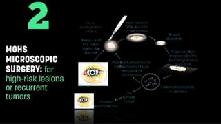 Squamous Cell Carcinoma