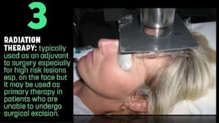 Squamous Cell Carcinoma