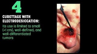 Squamous Cell Carcinoma